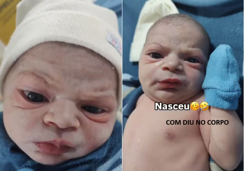 Bebê nasce com DIU