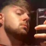 Influencer Galês sofre inchaço grave na cabeça após transplante capilar. Foto: Redes sociais